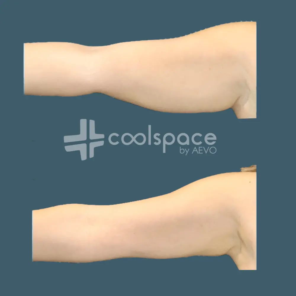 tratamiento-brazos-coolspace-clinicas-aevo