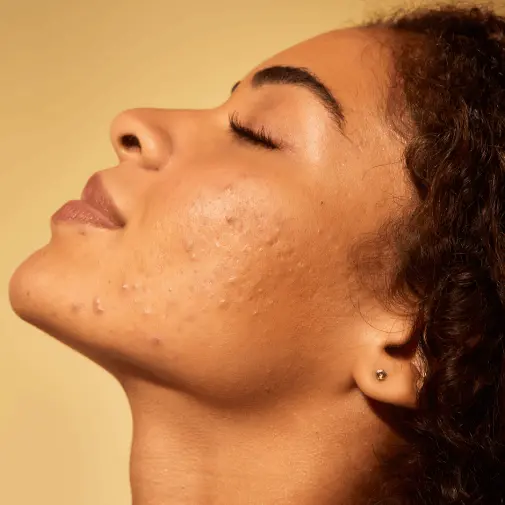 acido-hialuronico-clinicas-aevo