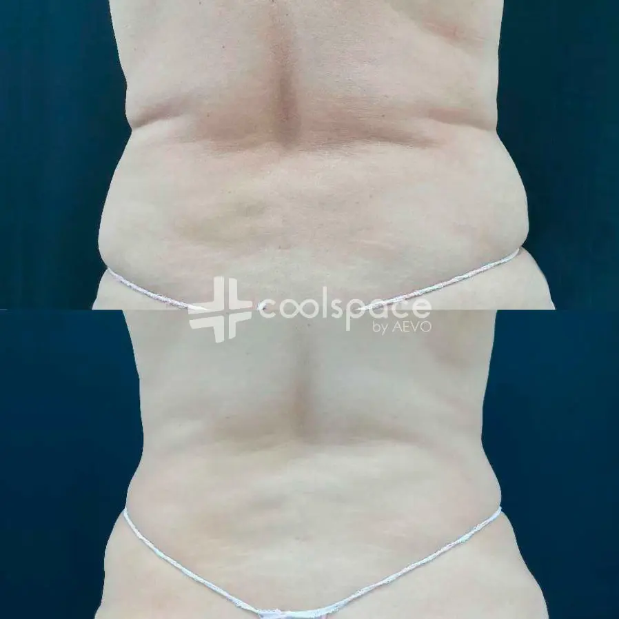 tratamiento-espalda-coolspace-clinicas-aevo