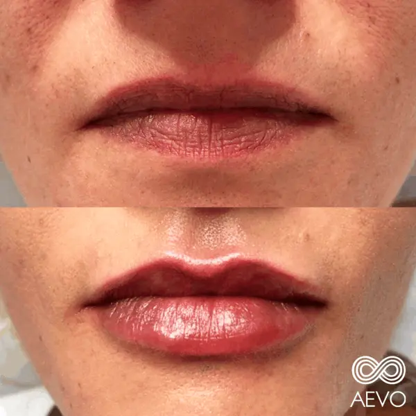 aument-de-labios-clinicas-aevo-medicina-estetica-facial-4