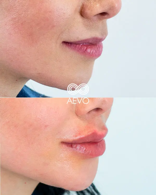 aument-de-labios-clinicas-aevo-medicina-estetica-facial-3