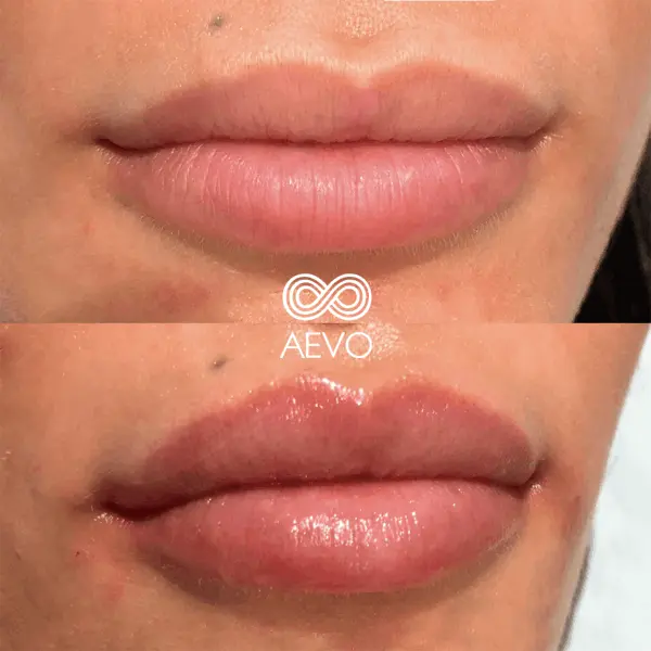 aument-de-labios-clinicas-aevo-medicina-estetica-facial-4