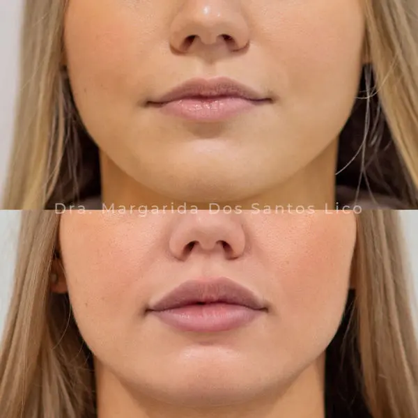 aumento-de-labios-clinicas-aevo-medicina-estetica-facial-1