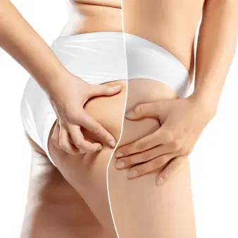 tratamiento-LPG Endermologie®