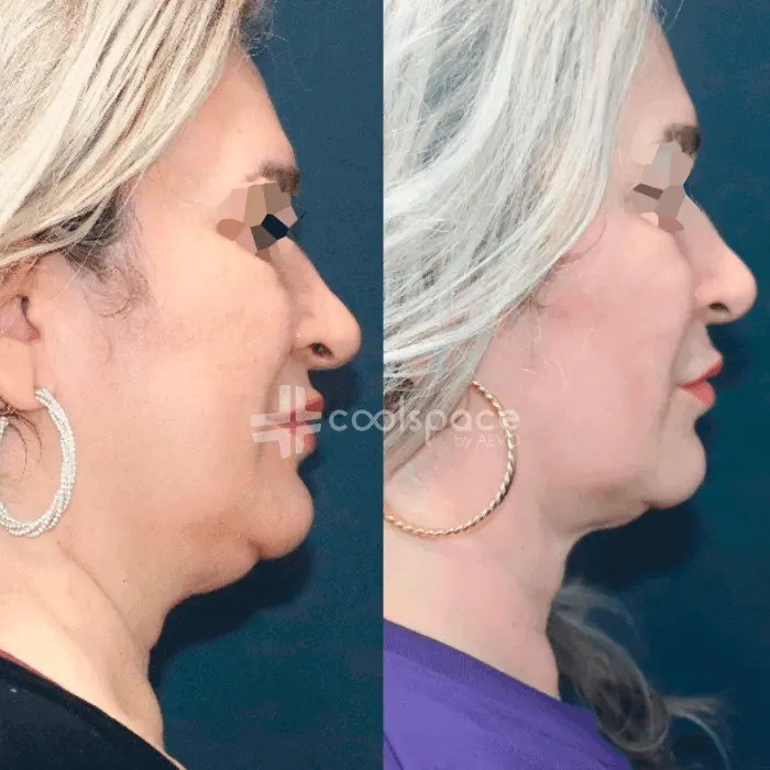 tratamiento-papada-coolspace-clinicas-aevo