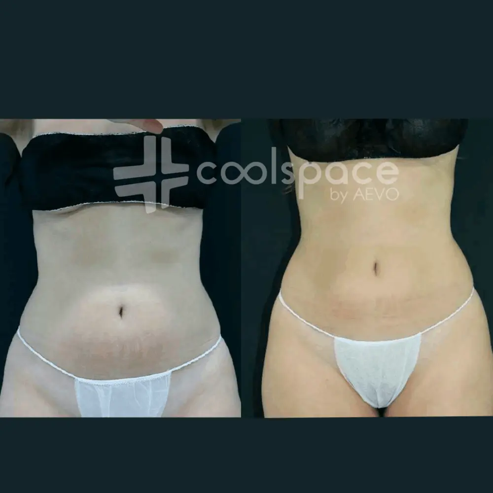 tratamiento-abdomen-coolspace-clinicas-aevo