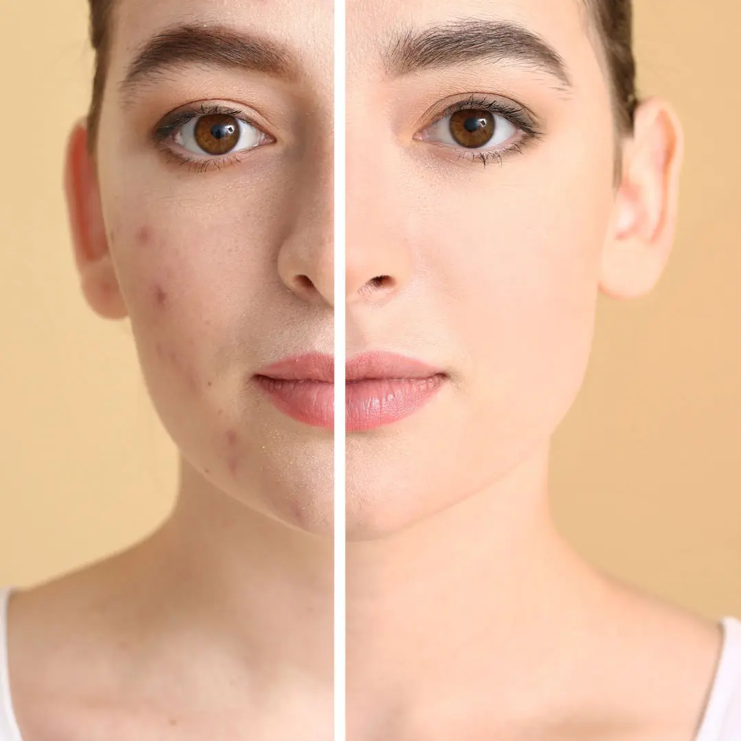 acido-hialuronico-clinicas-aevo