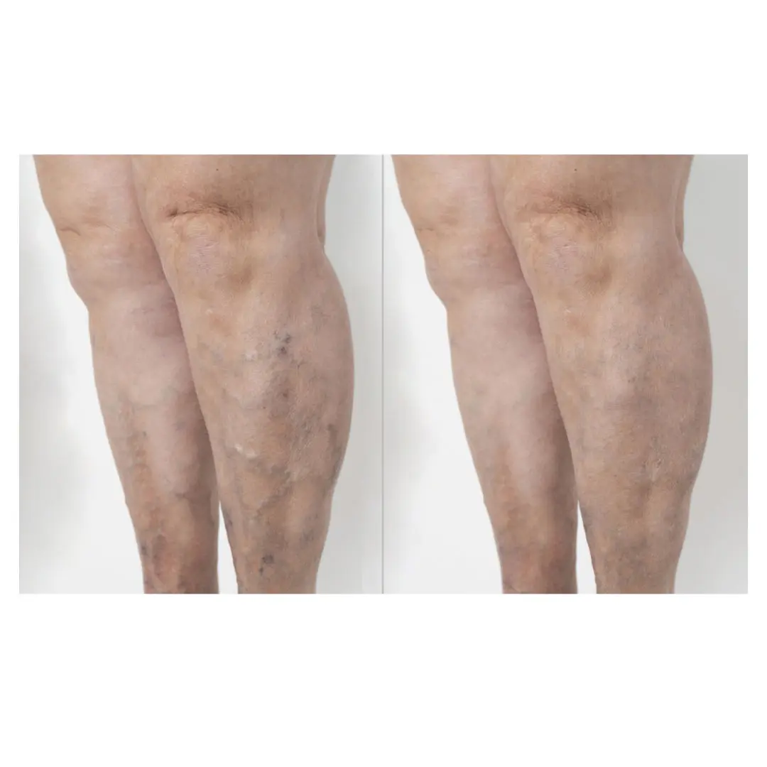 tratamiento-eliminacion de varices